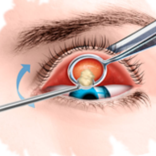 Cirurgia de calázio