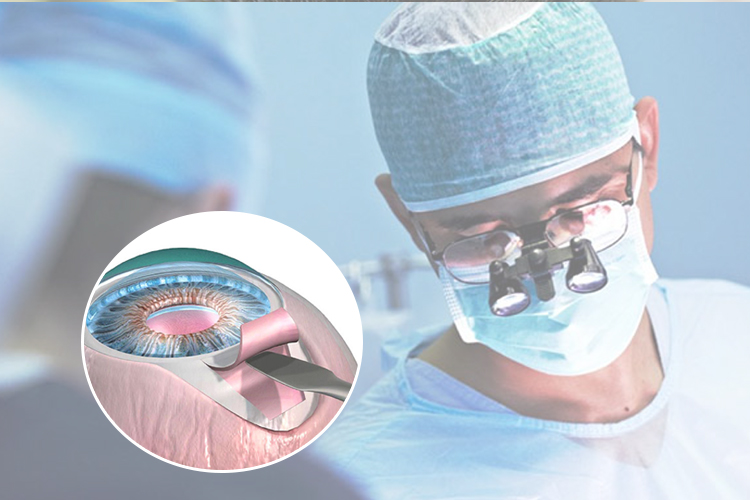 Cirurgia de glaucoma: conheça os procedimentos existentes