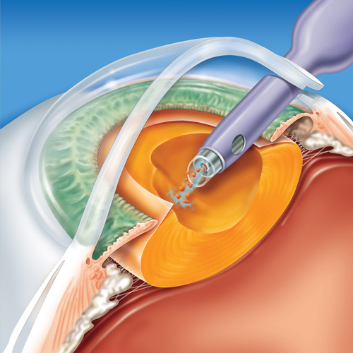 Cirurgia de Catarata ou Facectomia com Implante de Lente Intra-ocular